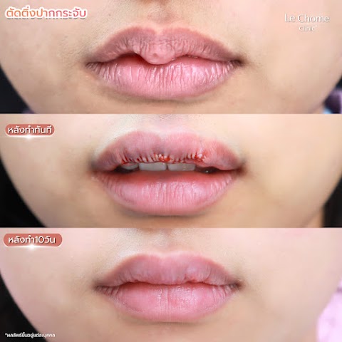 ตกแต่งริมฝีปาก