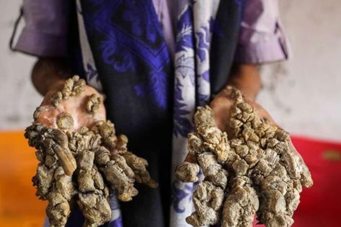 Dị nhân với đôi tay mọc như rễ cây: Căn bệnh hiếm với 25 ca phẫu thuật gây ám ảnh - Tạp chí Người Đưa Tin