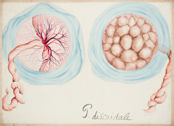 Discoid placenta 19th century