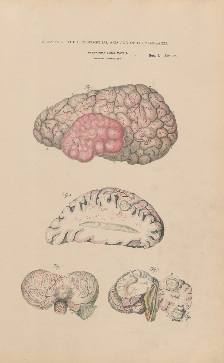 Haematoma Tubercular Meningitis 1888