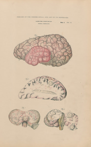 Haematoma Tubercular Meningitis 1888