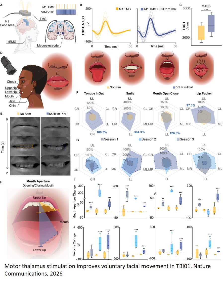 Frequency-dependent effects of motor thalamus deep brain stimulation on speech and swallowing
