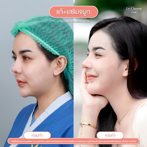 รีวิวเสริมจมูก — แก้+เสริมจมูก