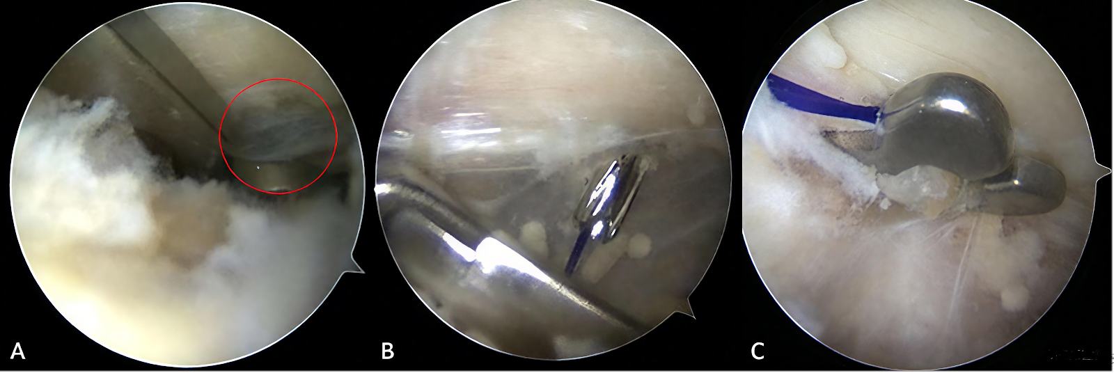 Arthroscopy-assisted loop titanium plate versus clavicular hook plate for acute acromioclavicular joint dislocation: clinical efficacy and cost-effectiveness