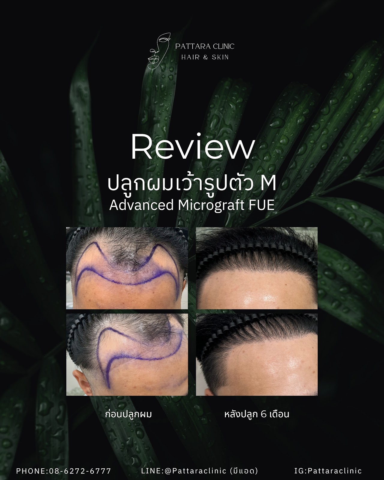 รีวิวปลูกผมถาวร FUE
