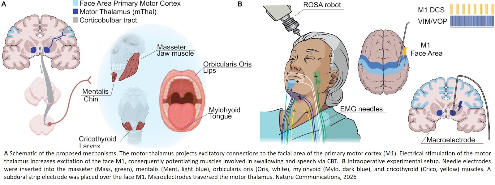 Low-frequency deep brain stimulation improves speech and swallowing after traumatic brain injury