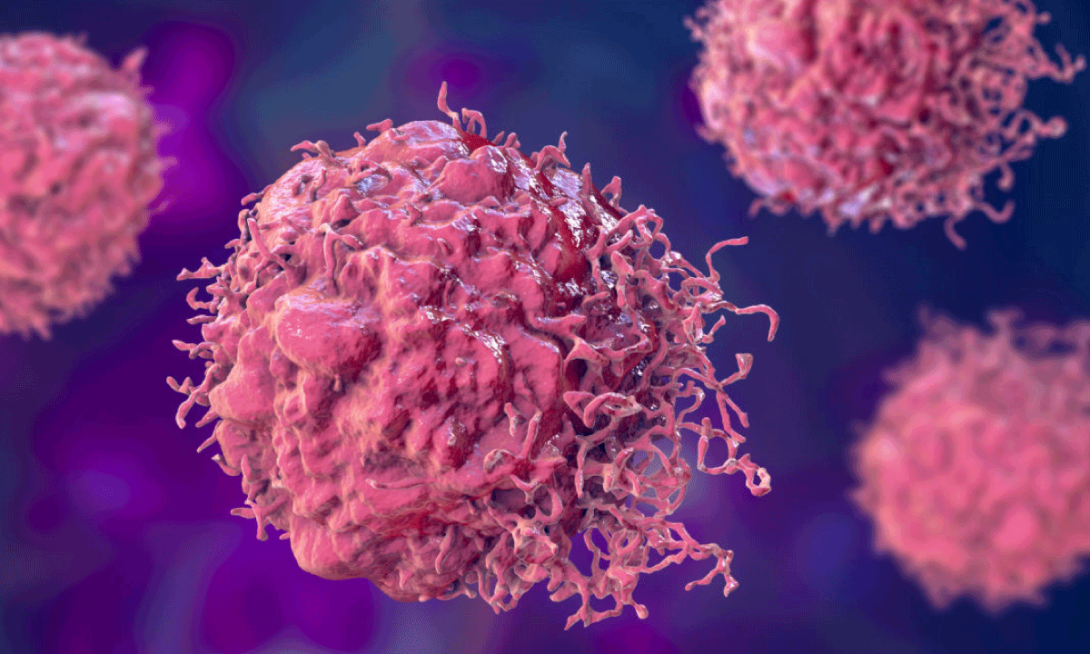 Aumento del cáncer de colon en menores de 50: un reto urgente para la gestión sanitaria global