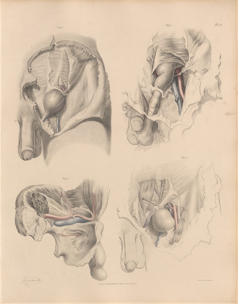 The position of the Epigastric artery with reference to different kinds of herni
