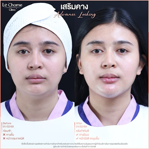 เสริมคาง