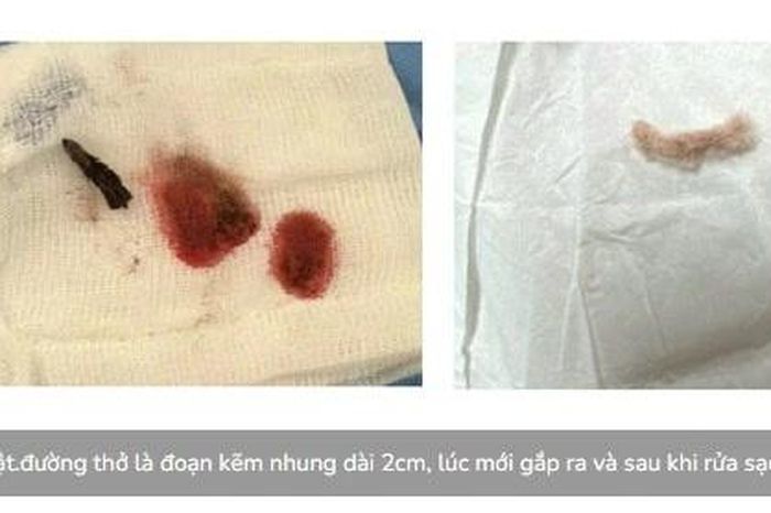 Kịp thời cứu trẻ 3 tuổi nuốt đoạn kẽm nhung dài 2cm - Báo Tri thức &amp; Cuộc sống