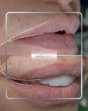 Smile Lift facial harmony aesthetic Dr Habib Zarifeh Smile Infinity Beirut full transformation case 6