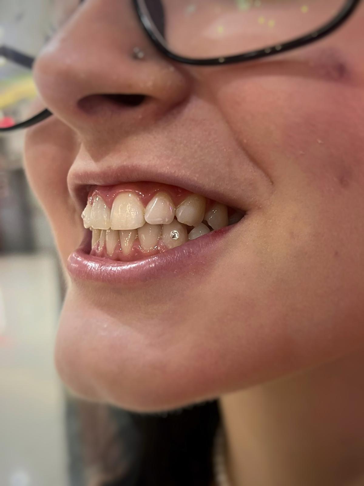 Gema dental minimal