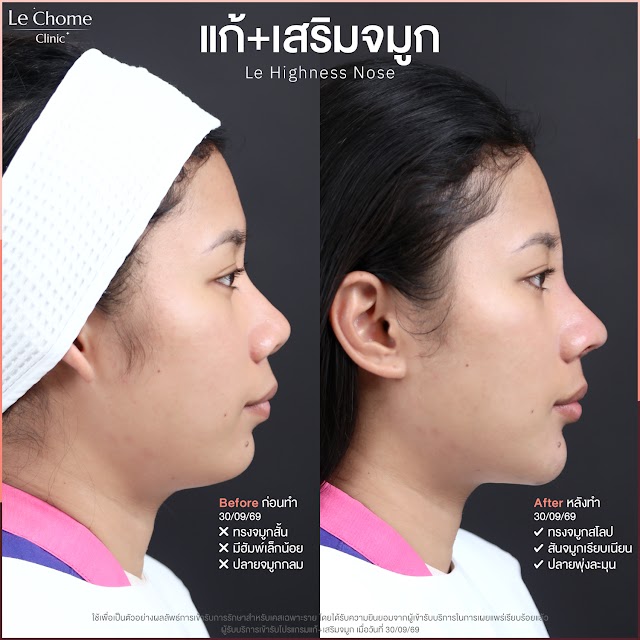 รีวิวเสริมจมูก — แก้+เสริมจมูก