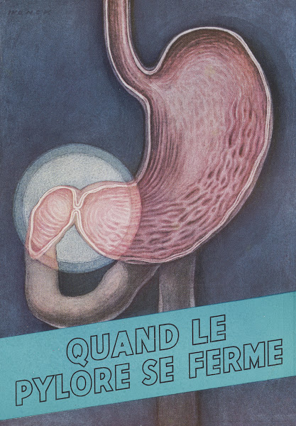 Quand le pylore se ferme 1910 1950