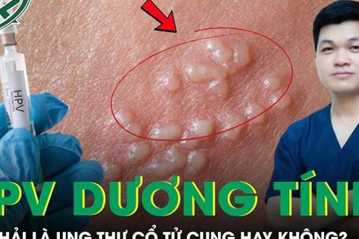 Có phải HPV dương tính là bị ung thư cổ tử cung không? - Báo Sức Khỏe &amp; Đời Sống