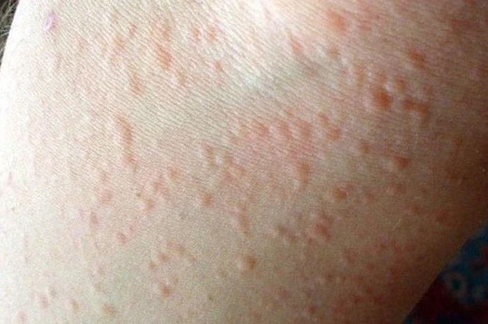 WHO cảnh báo: Nửa dân số thế giới có thể mắc dị ứng vào 2050 - Báo Tri thức &amp; Cuộc sống
