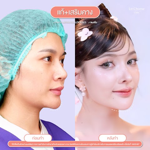 แก้ซิลิโคน+เสริมคาง
