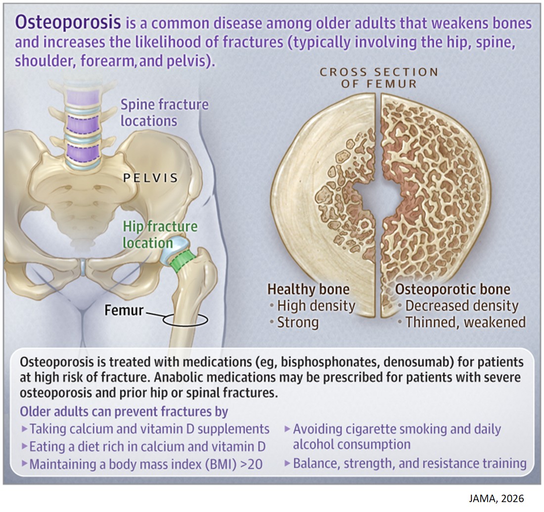 What Is Osteoporosis?