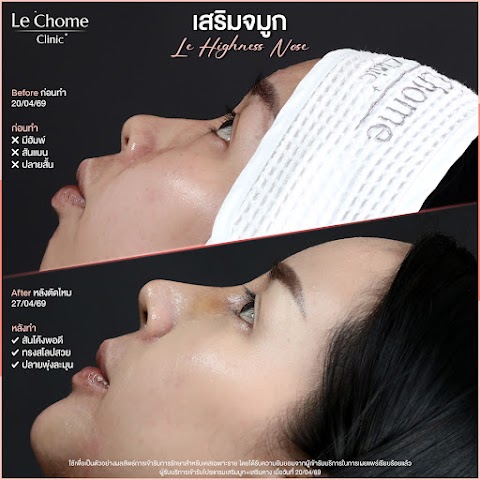 เสริมจมูก