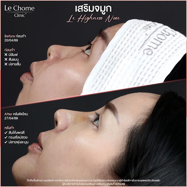 รีวิวเสริมจมูก — เสริมจมูก
