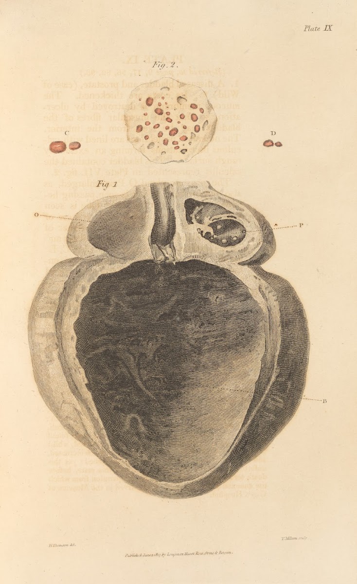 An Essay on the Chemical History and Medical Treatment of Calculous Disorders Pl
