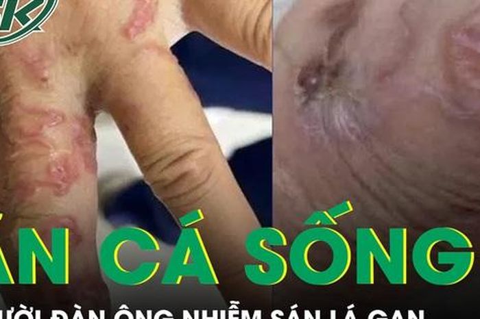 Ăn cá sống, người đàn ông bị nhiễm sán lá gan - Báo Sức Khỏe &amp; Đời Sống
