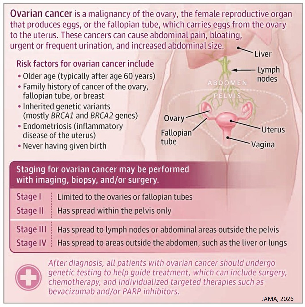What Is Ovarian Cancer?