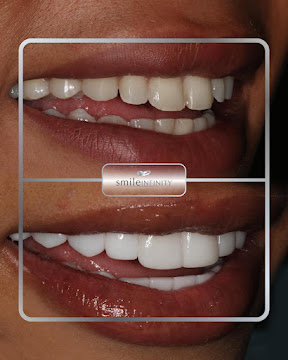 Hollywood smile veneers before after Beirut Lebanon Ferrari Dental Clinic Dr Habib Zarifeh CMC Hospital 2026
