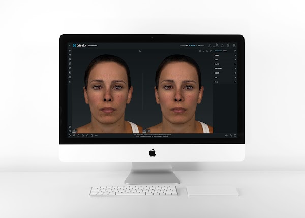 Ordinateur affichant l’interface de l’application Crisalix avec une simulation de visage 3D.