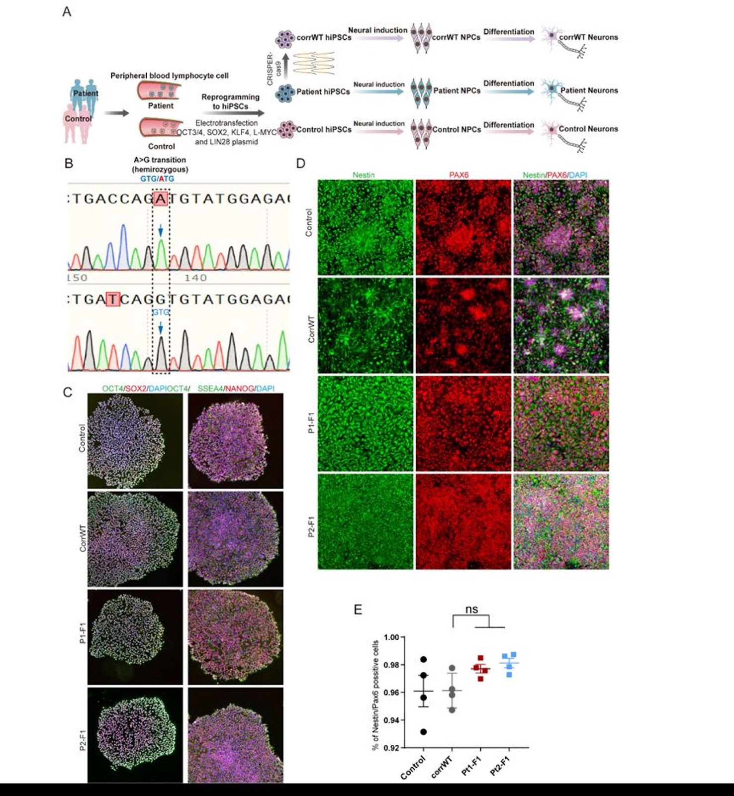 A novel OTUD5 variant disrupts neural progenitor cell homeostasis: mechanistic insights from HEK293T cell-based analyses