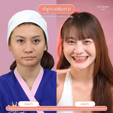 แก้ขูดฟิลเลอร์+เสริมคาง