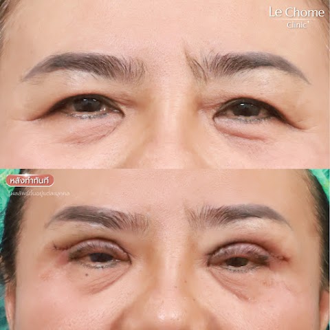 ตา 2 ชั้น