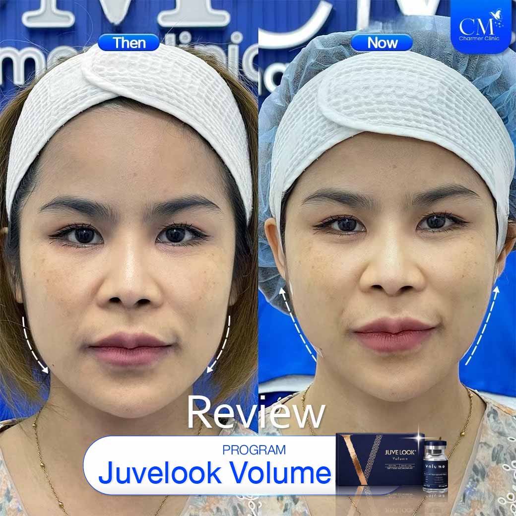รีวิว Juvelook Volume ผลลัพธ์