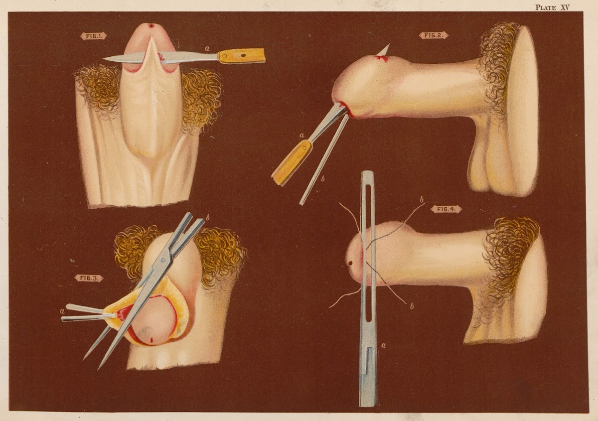 Operations upon the penis I 1889