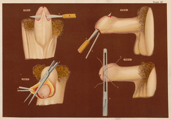 Operations upon the penis I 1889