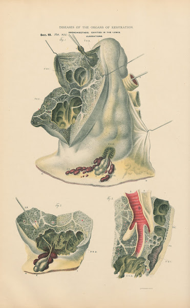 Bronchiectasis Cavities In Lungs Ulcerations 1888