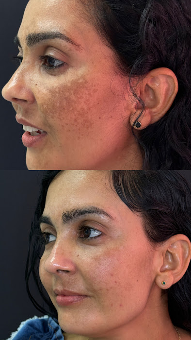 Antes e depois melasma