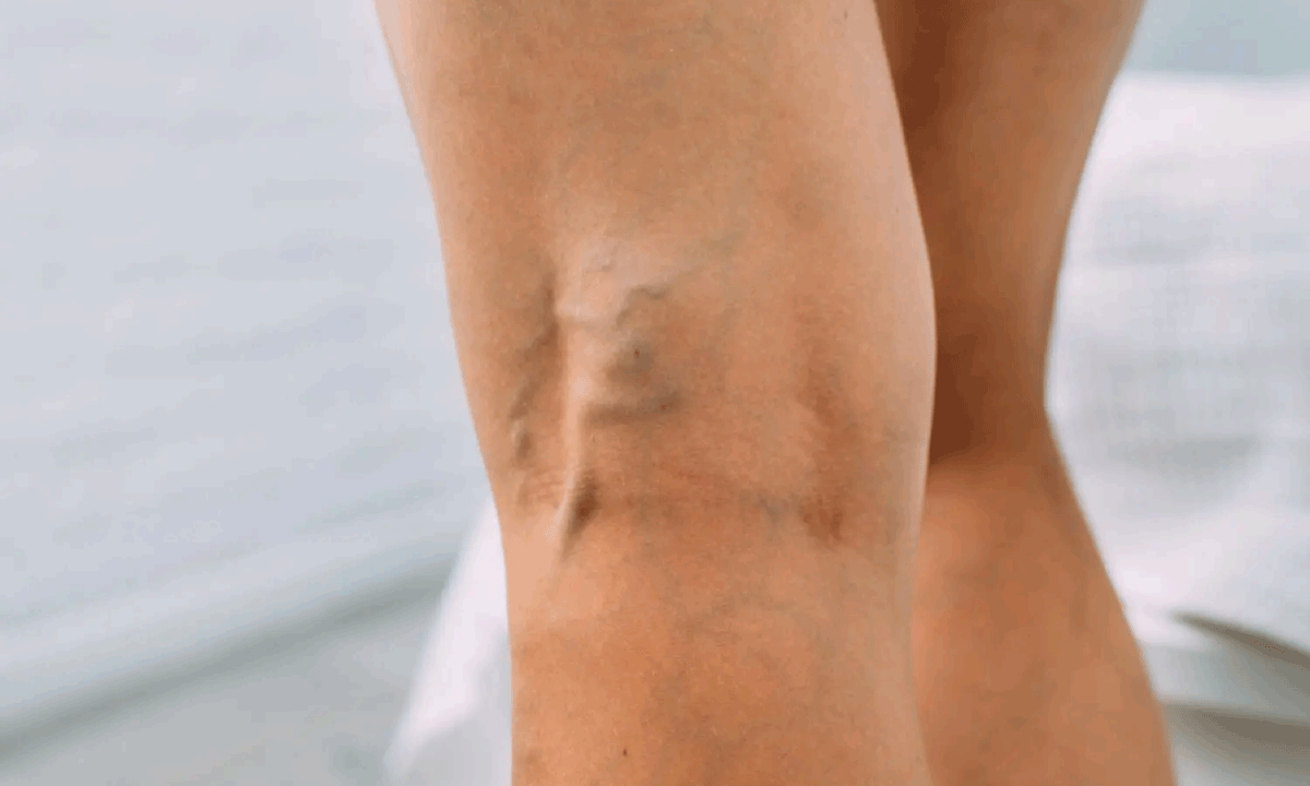 Global Health Focus: International Program Trains Medical Professionals in Phlebology and Venous Pathologies