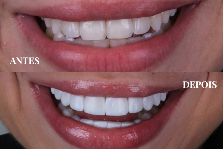 Caso clínico de facetas em resina em São Paulo SP - Antes e Depois