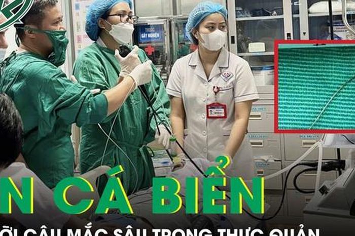Hiếm gặp: Ăn cá biển, người đàn ông bị lưỡi câu mắc sâu trong thực quản - Báo Sức Khỏe &amp; Đời Sống