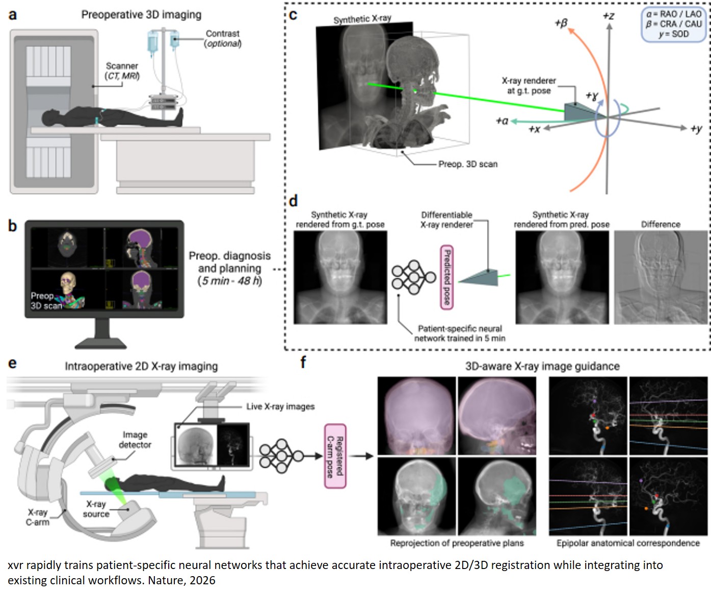 Rapid patient-specific neural networks for intraoperative X-ray to volume registration
