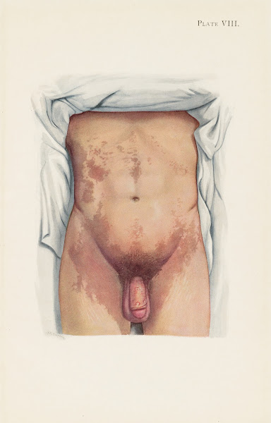 Plate VIII Brown staining from mustard gas 1918