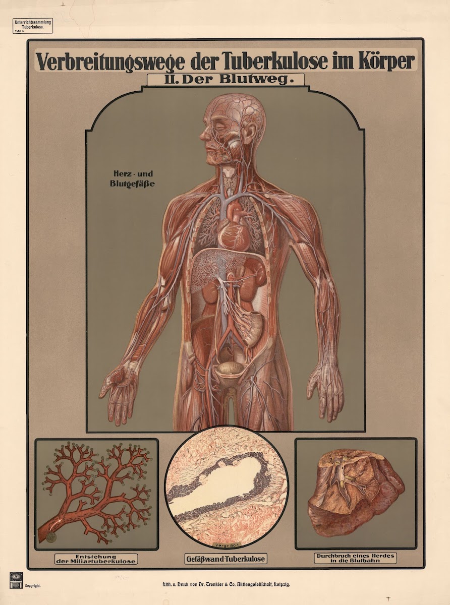 Routes of tuberculosis transmission in the body II The bloodstream 1920