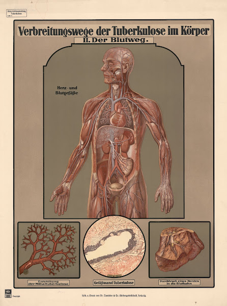 Routes of tuberculosis transmission in the body II The bloodstream 1920