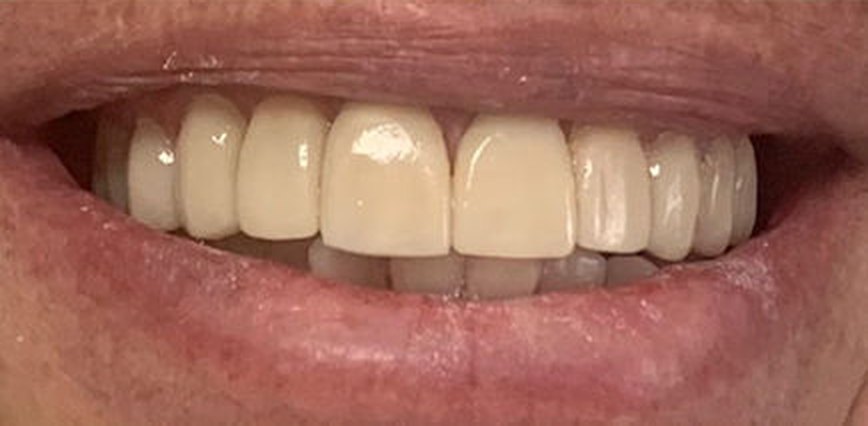Depois — Facetas, caso 1