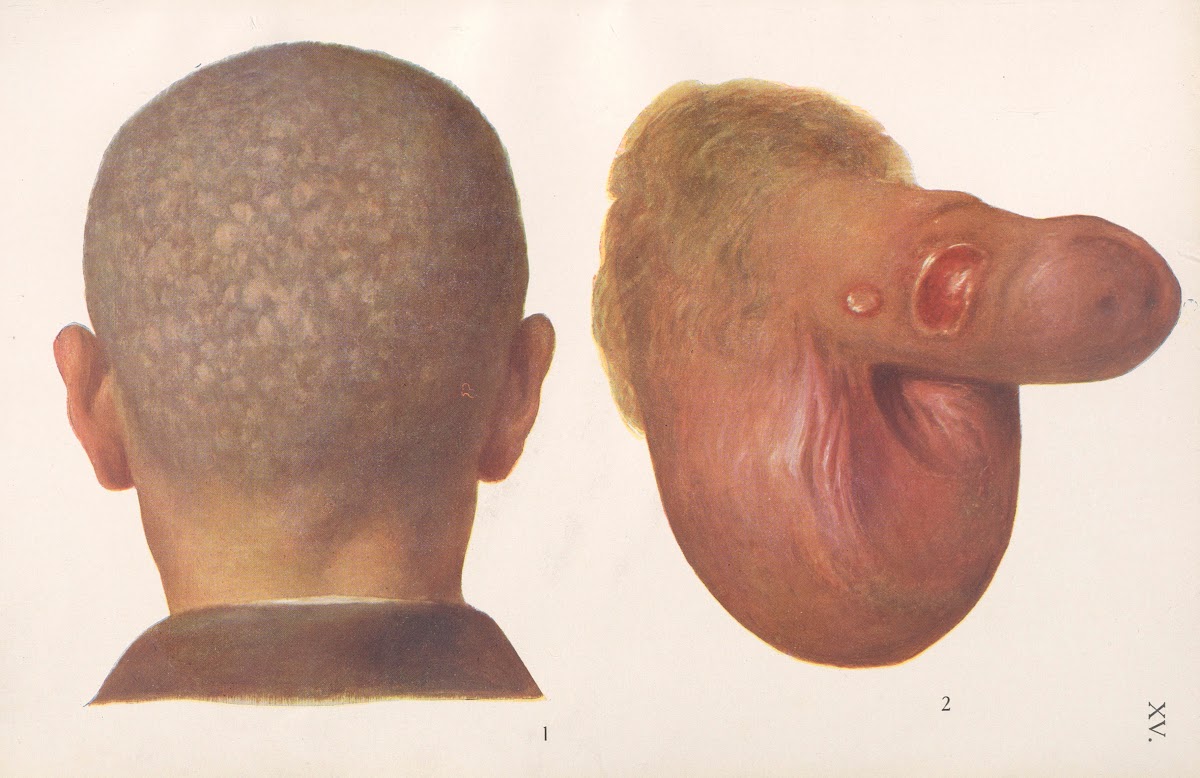 Venereal diseases  Syphilis Pl15 1908