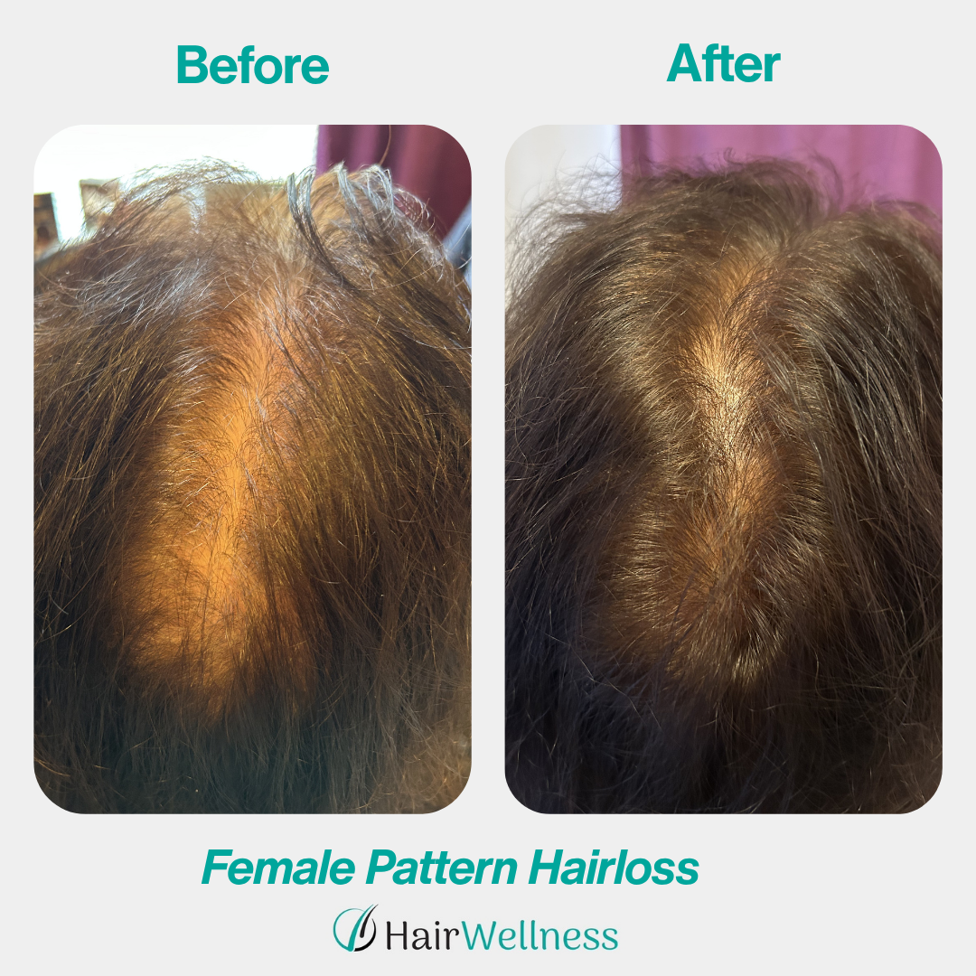 Female pattern hair loss treatment result