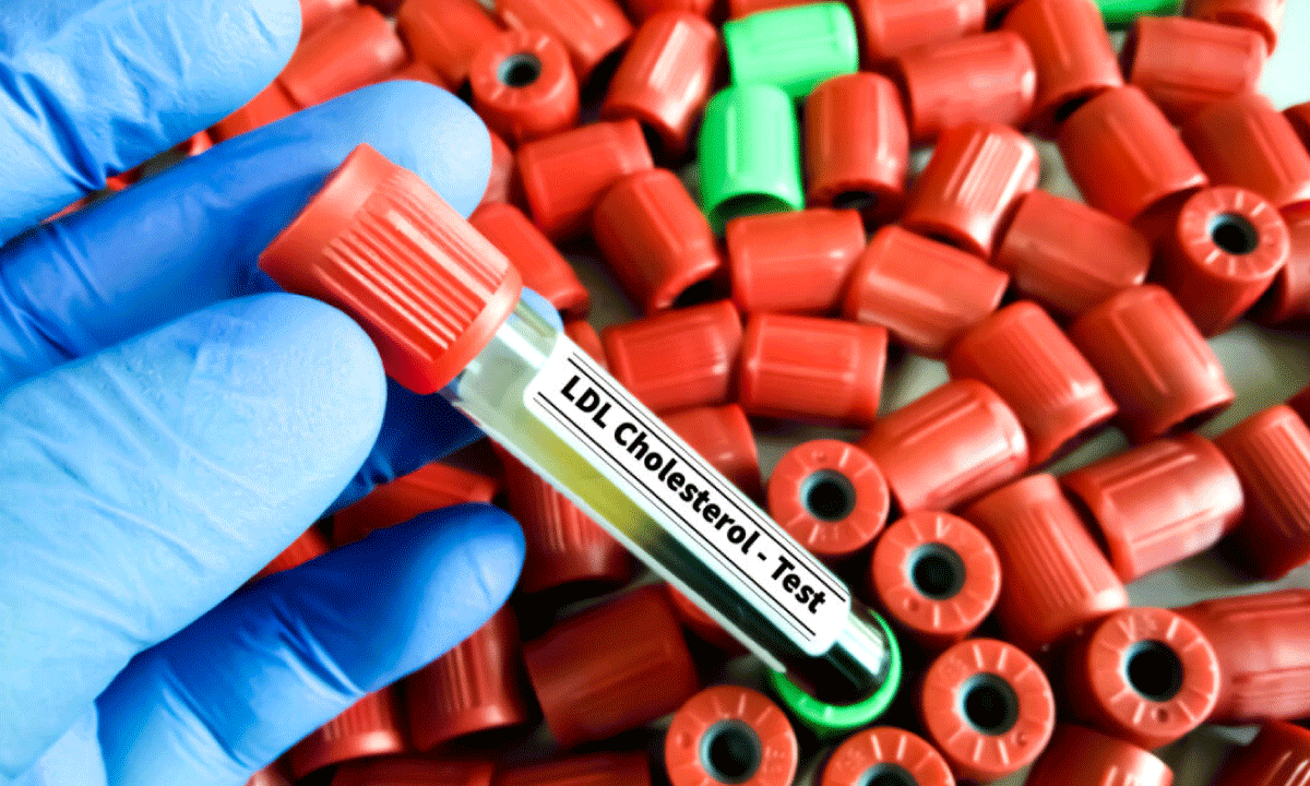 Nuevo medicamento oral logra reducir hasta un 60% el colesterol LDL en pacientes resistentes a estatinas