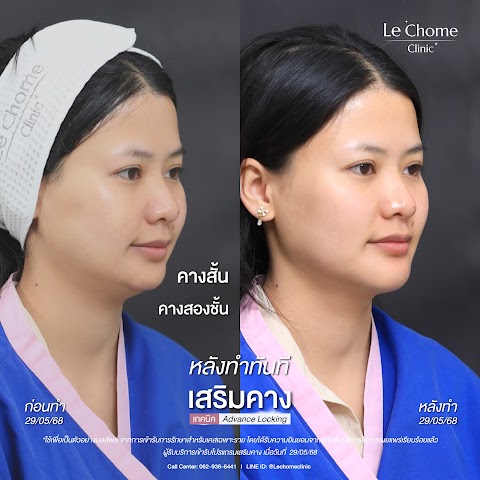 เสริมคาง (ใหม่)