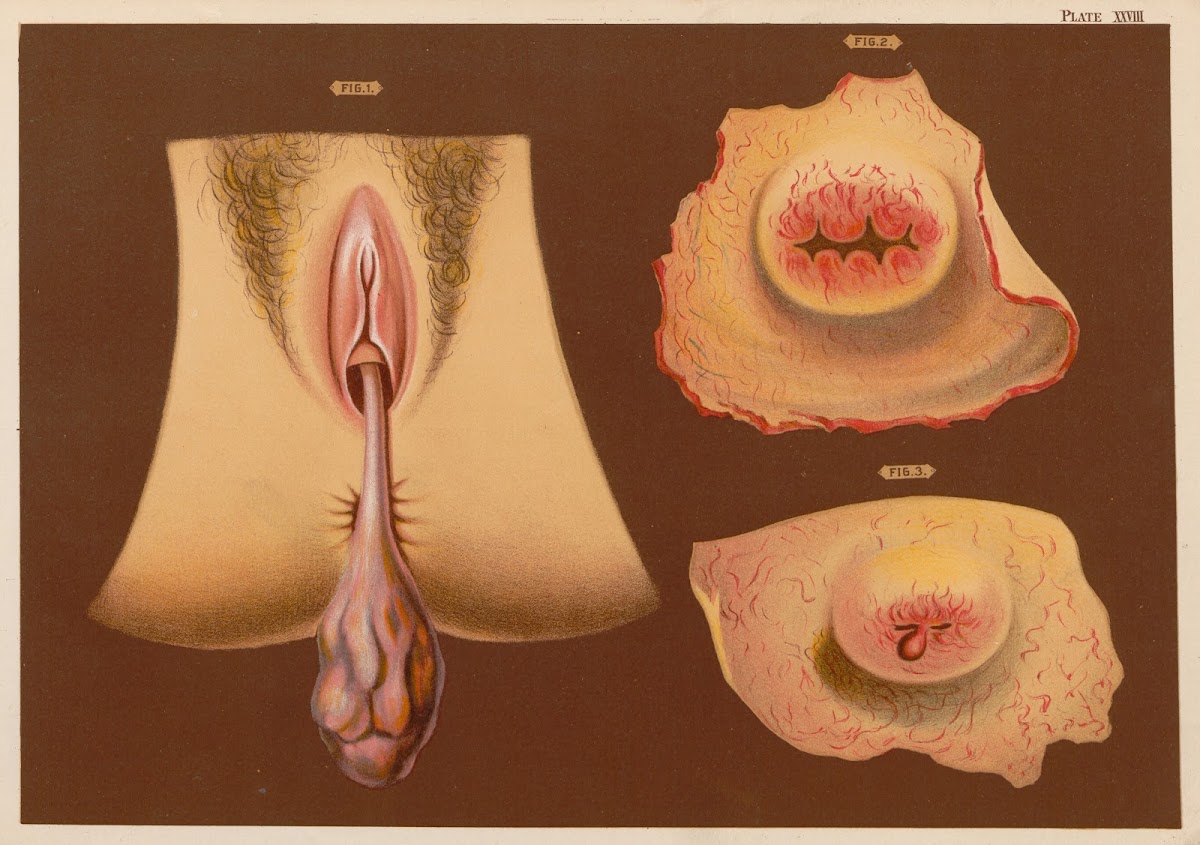 1 Pediculated Polypi 2 Fissure Of Os Uteri 3 Vesicular Polypi 1889